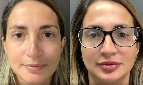 Lip Filler Transformation Volume Restoration Oakville Lip Doctor